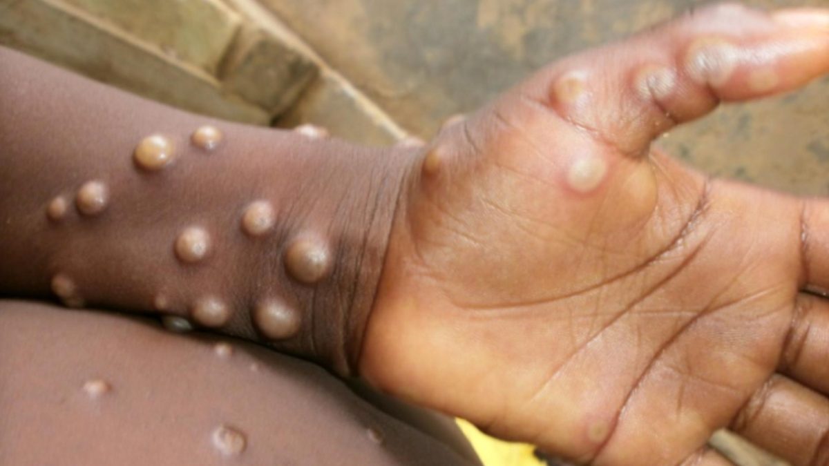 WHO Says Monkeypox Outbreak Can Be Contained